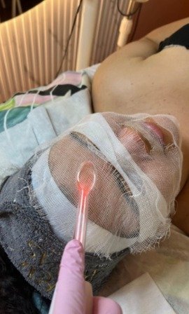 Resultado de limpieza facial profunda esencial