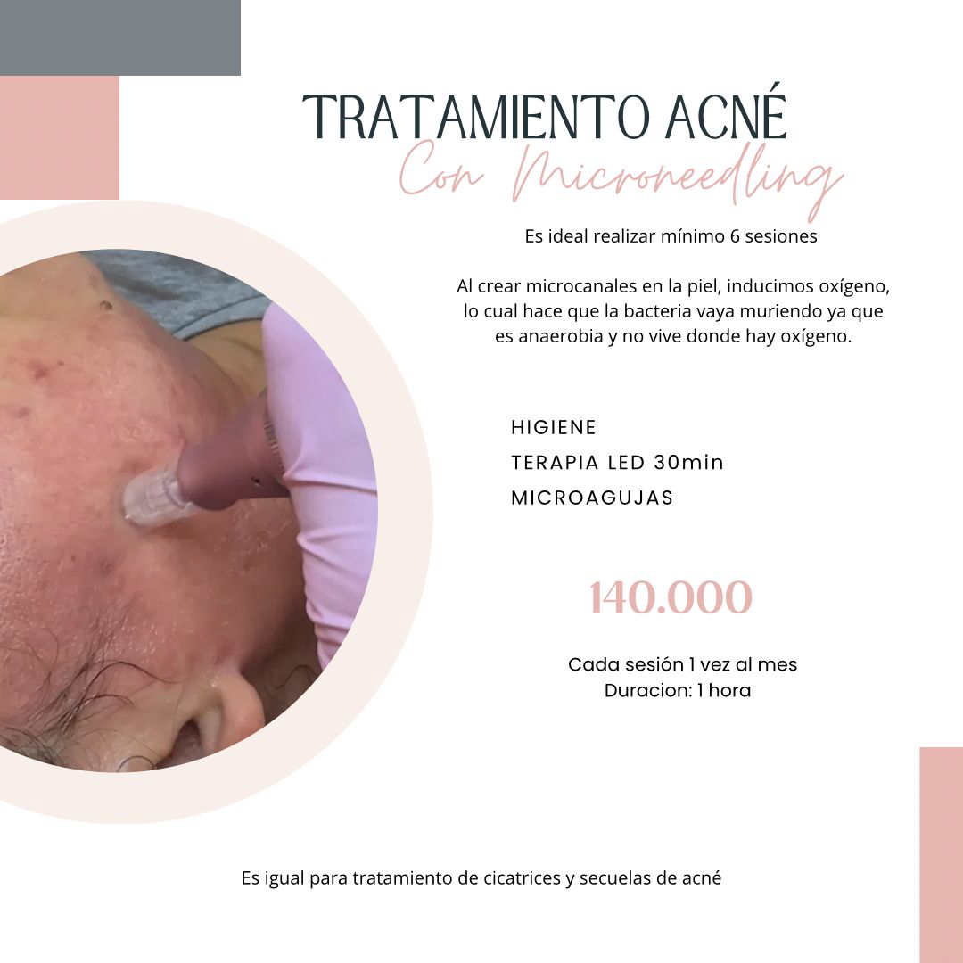 Tratamiento integral de acné